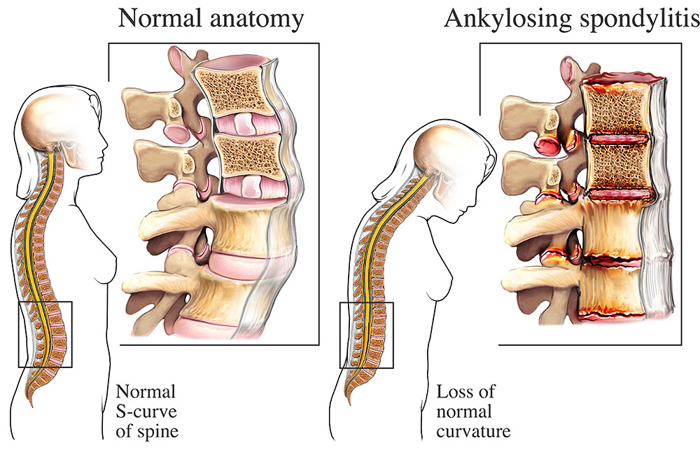 <p>An <strong>inflammation of the vertebrae (spinal joints)</strong> that causes <strong>pain and stiffness in the spine</strong>.</p>
