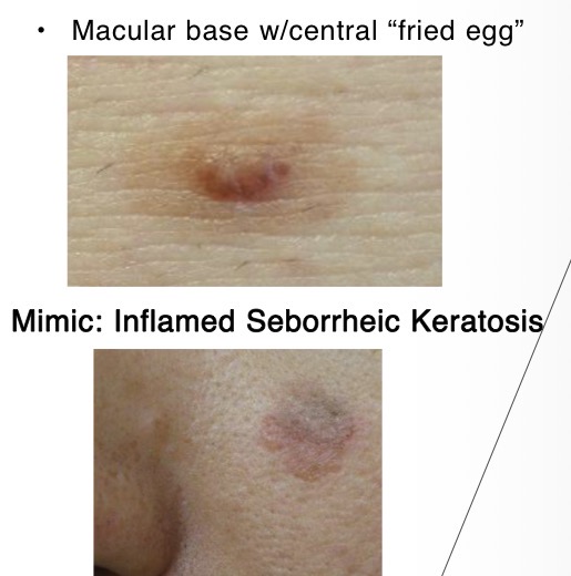 <p>Melanoma: </p><ul><li><p>can arise from existing nevi (benign)</p></li><li><p>varigated color (brown/reds)</p></li></ul><p>MIMIC: Dysplastic Nevus</p><p></p>