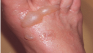 <p>2nd degree burn (superficial partial thickness) burn findings*</p>