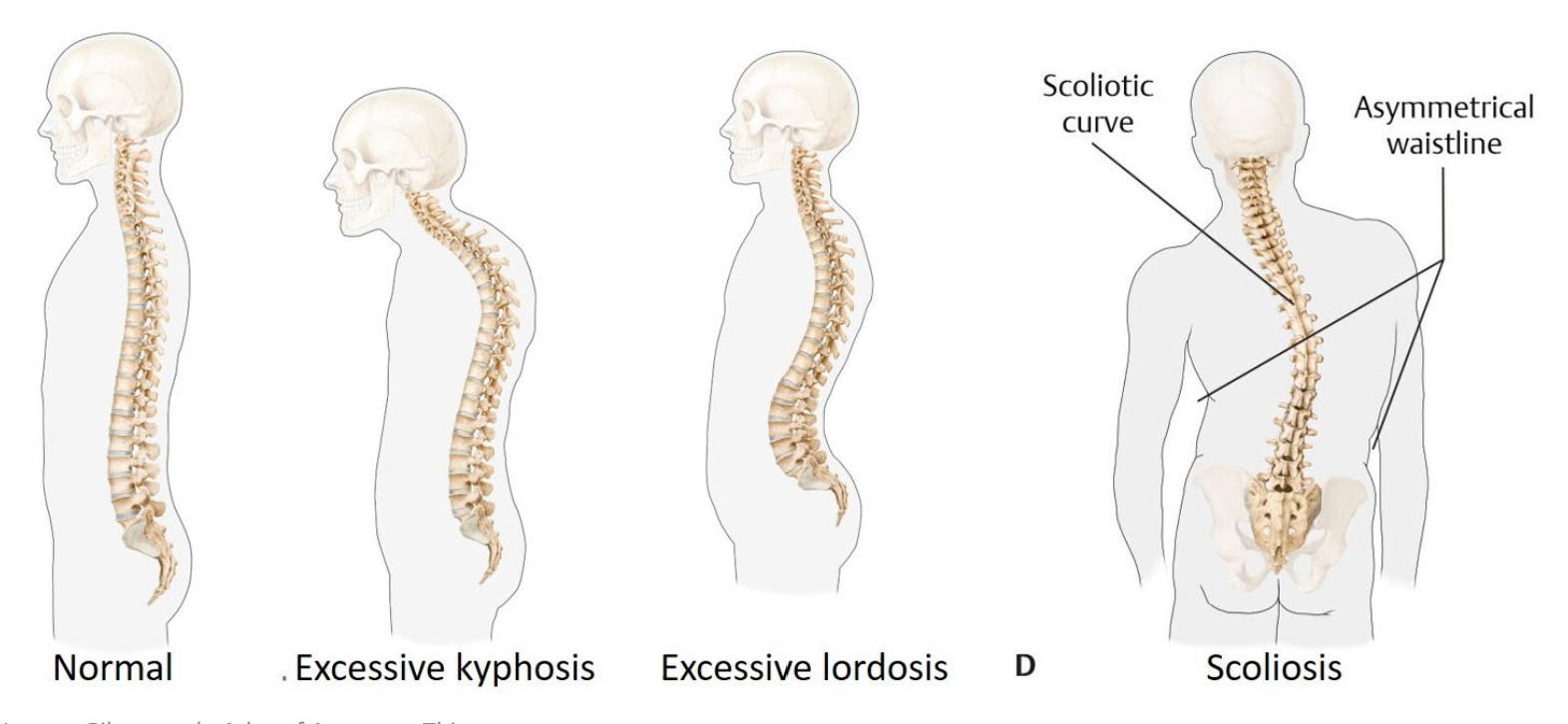 <ol><li><p>Excessive kyphosis: <span style="color: yellow;"><strong>thoracic curve increased</strong></span> (head/shoulders forward). </p></li></ol><p>.</p><ol start="2"><li><p>Excessive lordosis: <span style="color: rgb(255, 138, 233);"><strong>lumbar curve increased</strong></span> (often with anterior pelvic tilt). </p></li></ol><p>.</p><ol start="3"><li><p>Scoliosis:<span style="color: rgb(88, 249, 35);"><strong> lateral deviation with rotation </strong></span>— a curve in a plane the spine doesn't normally curve.</p></li></ol><p></p>