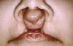 <ol start="20"><li><p>What syndrome is this likely associated with?</p></li></ol><p></p>