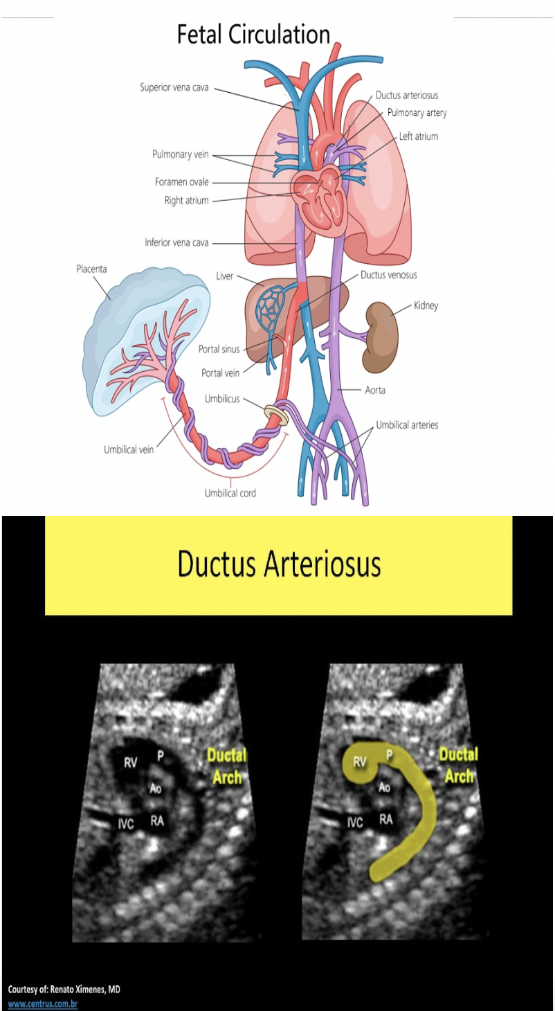 <p>D. ductus arteriosus</p><p>The foramen ovale describes the opening in the interatrial septum that allows normal shunting between the atria. It functions to as a shunt for the fetal flow to bypass the fetal lungs. The foramen ovale normally closes very soon after birth. The ductus arteriosus describes the connecting vessel from the main pulmonary trunk to the descending aorta in fetal circulation. It functions as a shunt to bypass the fetal lungs. The ductus venosus describes the vessel that shunts blood flow around the fetal liver in fetal circulation. Both ductus connections also close shortly after birth.</p>