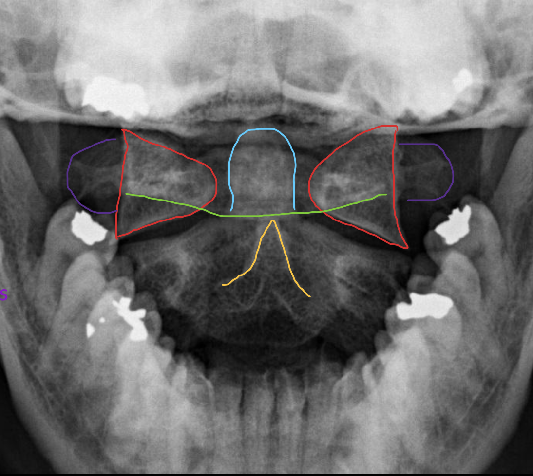 <p><span>寰椎侧块</span></p>