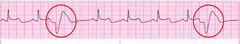 <p>Premature ventricular contractions (PVCs)</p>