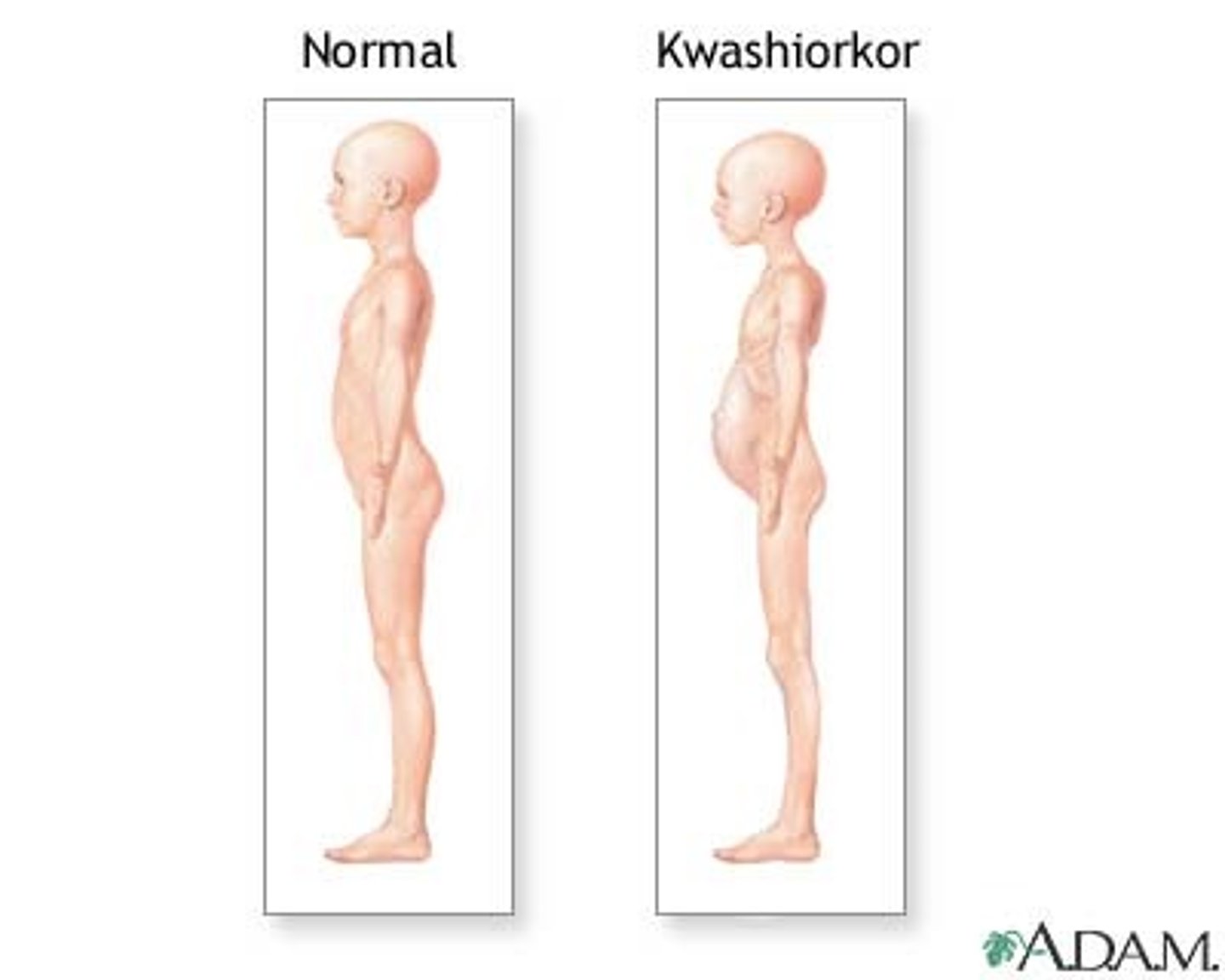 <p>Protein deficiency with adequate calorie intake; causes edema, swollen belly, irritability, and enlarged liver.</p>
