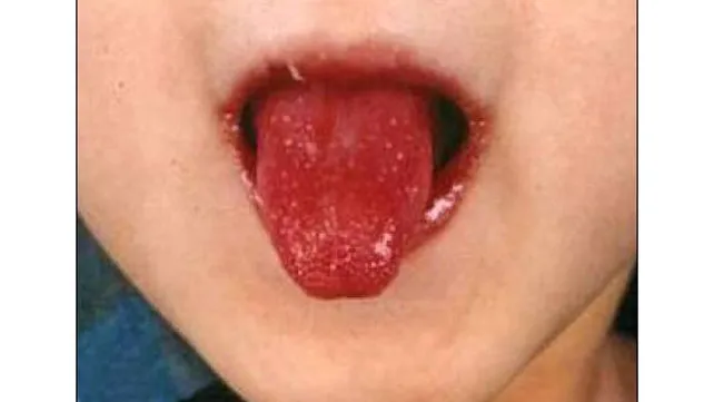 <p>8 yo has sore throat, chills, vomiting, exudative tonsillitis, pallor, and strawberry tongue with pasture lines. tx?</p>