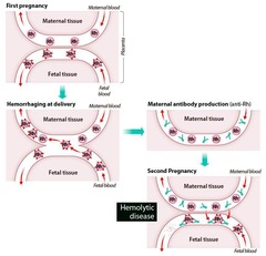 <p>An attack on fetal RBCs by the maternal immune system.</p>