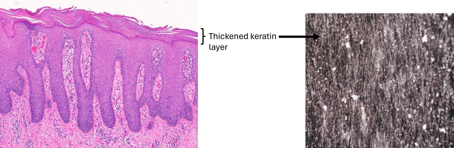 <ul><li><p><strong>excess of surface layer (stratum corneum) of the epidermis</strong></p></li><li><p>primary only in <strong>congenital</strong> ichthyosis</p></li><li><p>common <strong>secondary finding</strong> in many diseases</p></li><li><p>increased rate of keratinocyte proliferation OR delayed shedding of keratin</p></li></ul><p></p>