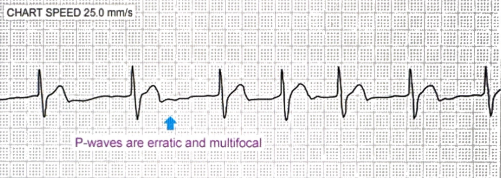 <p>Irregularly irregular rhythm with no distinct P waves</p>