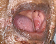 <p>erosions or flaccid bullae</p>