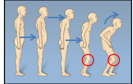 <p><span>•Forward head position</span></p><p><span>•Rounded Shoulders</span></p><p><span>•Kyphosis (rounded back)</span></p><p><span>•Knee flexion</span></p>