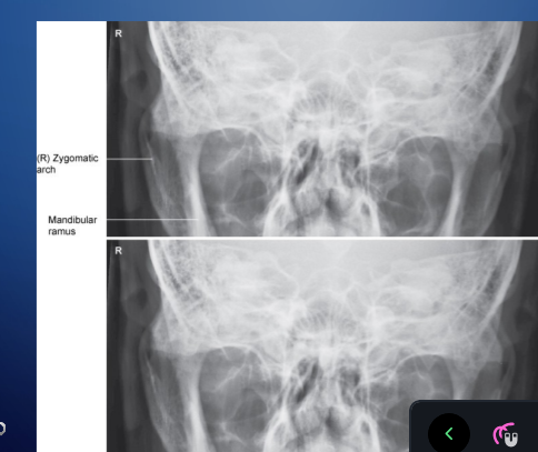 <p>sym AP axial bilat adrches</p><p>mandibular ramus</p>