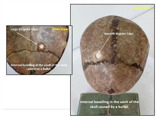 <p></p><div data-type="horizontalRule"><hr></div><p>Questions</p><ol><li><p>What is the specimen being examined?</p></li><li><p>What are the specific structural differences between the openings of the outer and inner tables of the skull?</p></li><li><p>What is the specific pathological term used for this type of skull bone involvement?</p></li><li><p>What are the precise anatomical measurements and landmark relations of the injury site?</p></li><li><p>What type of causative instrument produced this injury?</p></li><li><p>How is the time of death estimated?</p></li><li><p>What are the possible causes of death?</p></li><li><p>What is the final diagnosis?</p></li></ol><div data-type="horizontalRule"><hr></div><p></p>