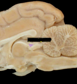 <p>• Also called the pineal body</p><p>• Small, beanshaped structure located caudal to the thalamus</p>