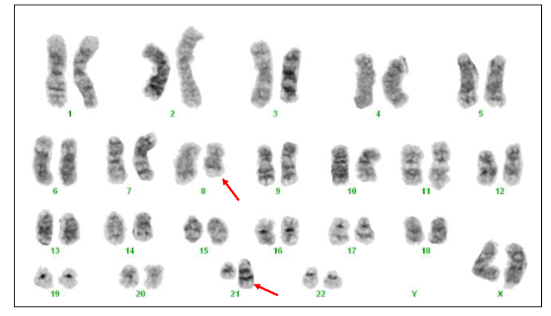 <p>- t(8;21)(q22;q22) RUNX1::RUNX1T1</p><p>- Approximately 5% AML. Generally young patients. Leukaemic blast cells have cytoplasmic granules. Favourable prognosis (likely to achieve complete remission)</p>