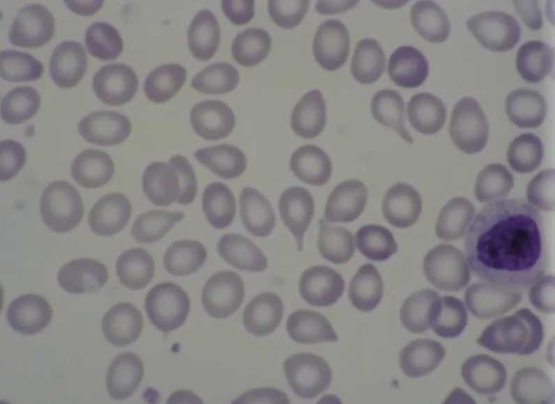 <p>teardrops are associated with what condition?</p>