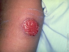 <p>+ Patient recently visited Central America and was bitten by something</p>
