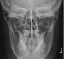 <p><span style="background-color: transparent;">Mandible PA for body</span></p>