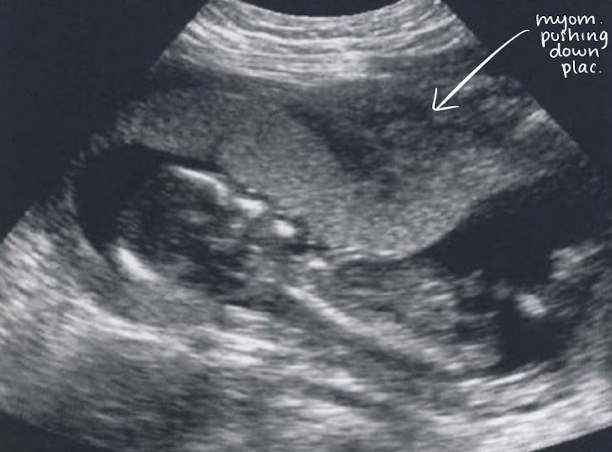 <ul><li><p>practice/false contractions</p></li><li><p>transient myometrial (uterine wall) contraction</p></li><li><p><span style="color: red;">created appearance of a placenta mass</span> (distorts placenta shape)</p></li></ul><p></p>