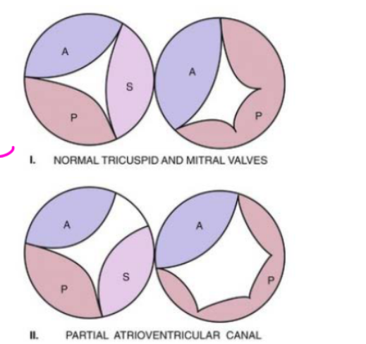 <p>A partial AVSD consists of:</p><ol><li><p>Primum ASD</p></li><li><p>Cleft mitral valve</p></li></ol><p>It may also include a <strong>common atrium</strong>.</p>