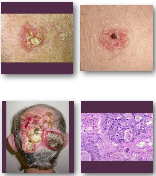 <p><strong>•Malignant tumor of keratinizing epithelium</strong></p><p>•Strongly linked to<strong> chronic UV exposure</strong></p><p>•May arise from actinic keratosis lesions</p><p><strong>•More aggressive than basal cell carcinoma</strong></p><p>•Risk increased in immunocompromised patients</p><p></p>
