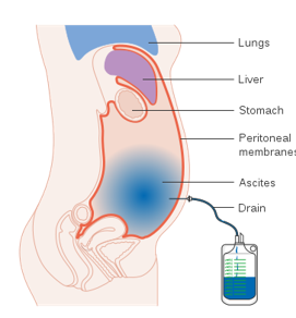 <p>paracentesis </p>