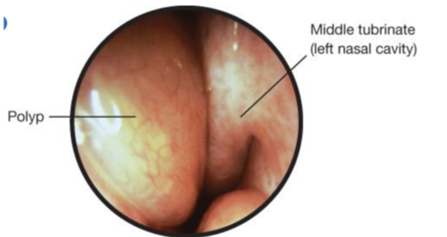 <p>are pale saclike growths of inflamed mucosa that can obstruct the air passage or sinuses, seen in allergic rhinitis, aspirin sensitivity, asthma, chronic sinus infections, and cystic fibrosis.</p>