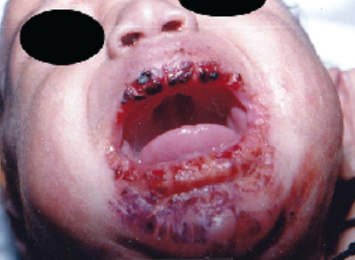 <p>caused by <span style="color: rgb(192, 0, 0);">treponema pallidum </span></p><p><strong>treatment:</strong><span style="color: rgb(192, 0, 0);"> </span><span style="color: red;">metronidazole / penicilin</span></p><p>fissures that occur as a result of <strong>syphilis</strong>, typically at the mouth's corners</p>