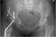 <p>Refer to pediatric orthopedics</p><p><8 yr old: Observation, NWB until re-ossification, close follow up, 60% will not require surgery (w/ early intervention)</p><p>>8 yr old: Surgical intervention</p><p>Potential need for total hip in later adulthood</p>