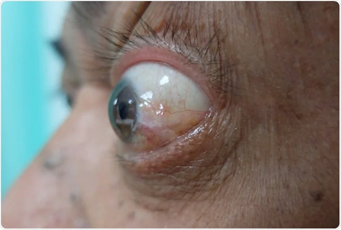 <p><span style="background-color: transparent; font-family: "Times New Roman", serif;">Exophthalmos</span></p>