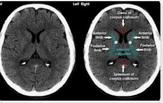 <p>Internal capsule, CT, transverse</p>
