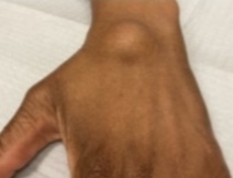 <p>Pt went for surgery to remove a cyst what tendon can be affected </p>