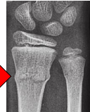 <p>What fracture is this?</p>