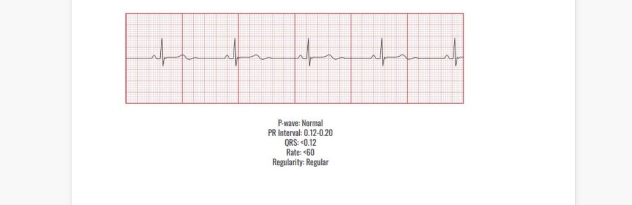 <p><span>Causes</span></p><p></p><p><span>Sleep</span></p><p><span>Inactivity</span></p><p><span>Very athletic</span></p><p><span>Drugs</span></p><p><span>MI</span></p><p><span>Interventions</span></p><p></p><p><span>Fix the cause!</span></p><p><span>Atropine</span></p>