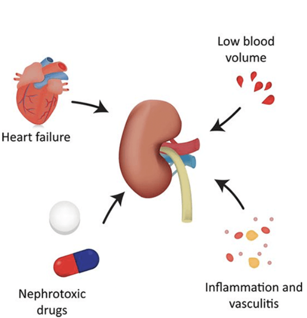<p>What is Acute Kidney Injury (AKI)?</p>