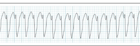 <p>what does this EKG show?  (QRS complex overrides T wave)</p>