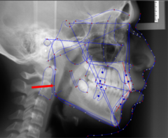 <p>which anatomical landmark:</p><p>- Most posterior point on the border of the inferior ramus</p>