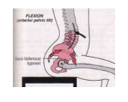 <p>Excessive lordosid </p>