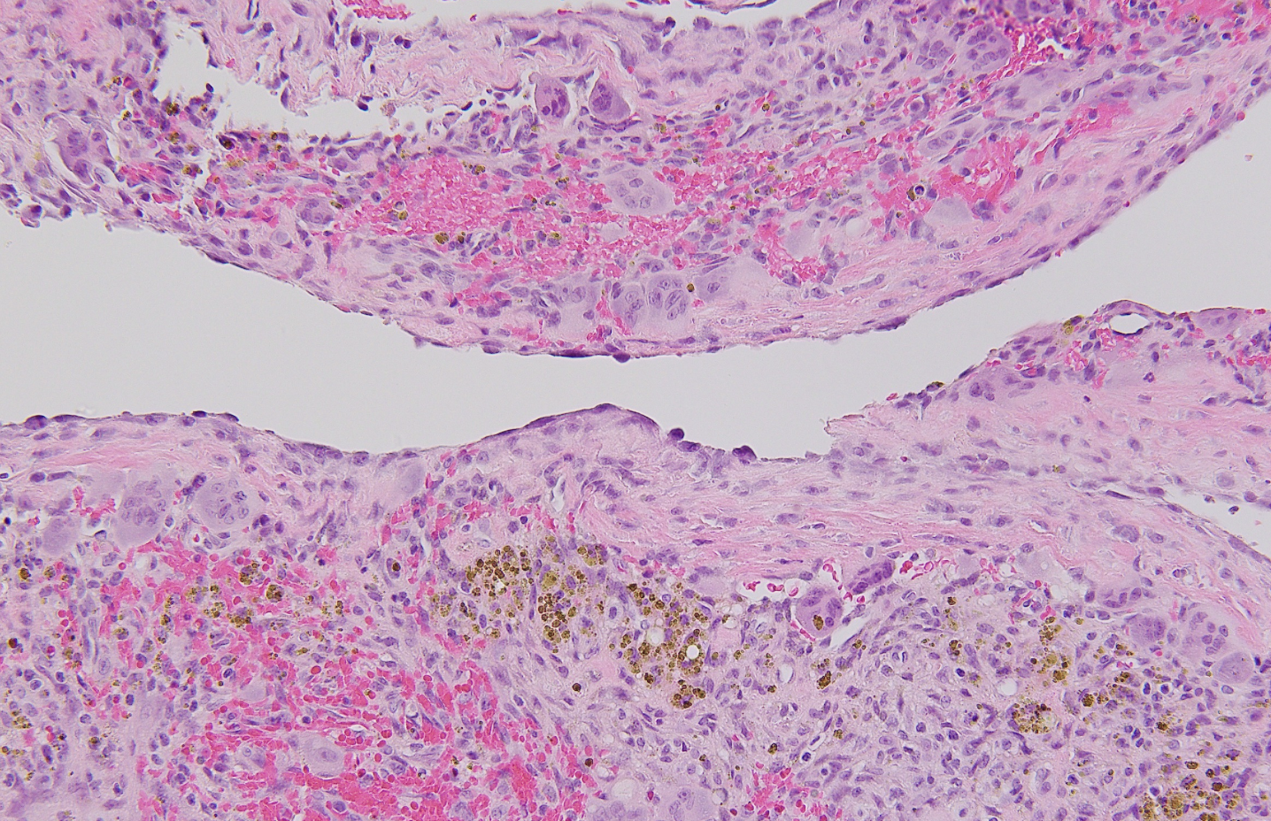 <p>Tumeur osseuse kystique jeune, fémur</p><p>diagnostic</p><p>définition</p><p>age</p><p>anatomie</p><p>histologie</p><p>IHC et moléculaire</p>