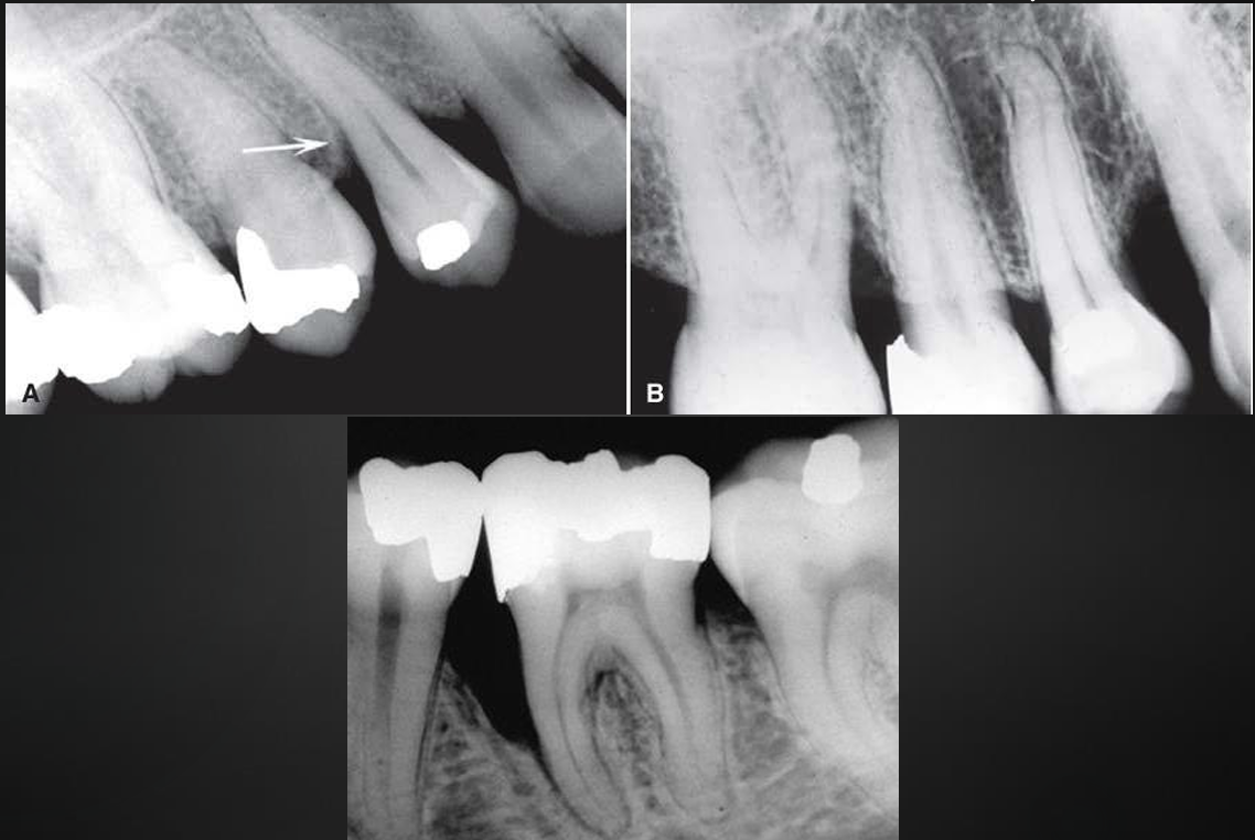 <p>what kind of bone loss is this?</p>