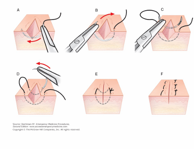 <p>-good for wounds under high tension (back, chest, over joints)</p><p>-good for hemostasis</p>