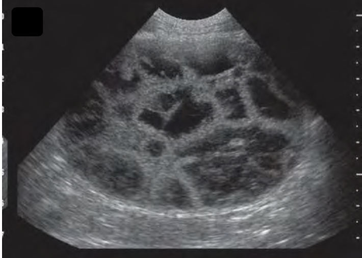 <p>what is occurring in the following ultrasound?</p>