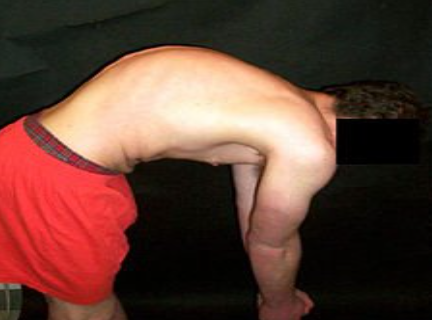 <p>What back mis-alignment is this?</p>