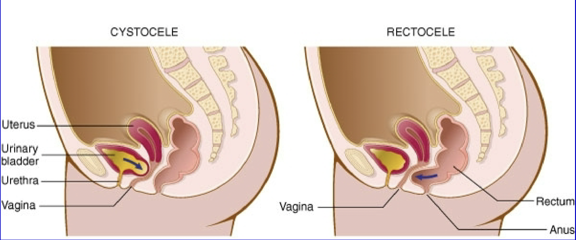 <p>protrusion of an organ through the cavity that normally contains it</p><p>EX: cystocele, rectocele</p>
