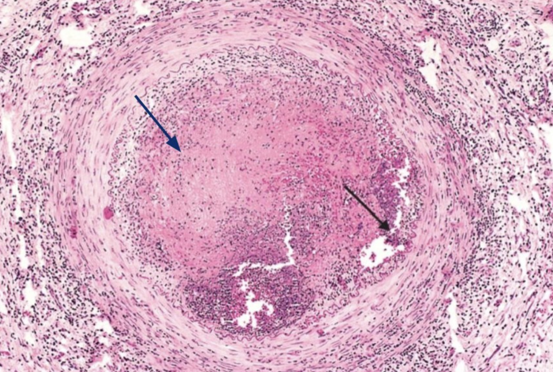 <p>Combination of thrombosis + vascular inflammation with neutrophils within the same vessel</p>