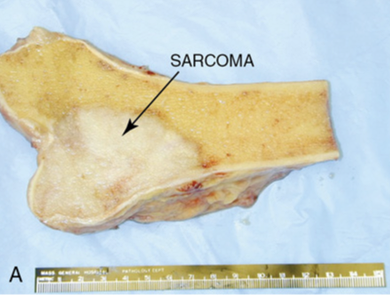 <p>Malignant tumor arising from connective tissues: 육종, 결합조직에서 발생하는 악성 종양<br><br>fig. Sarcoma of the bone(osteosarcoma) <br>def. Sarcomas grow from connective (supportive) tissue such as bone, fat, muscle, and cartilage.</p>