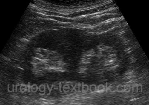 <p>complete duplication of collecting system </p><ul><li><p>two distinct renal sinuses </p></li></ul><p></p>