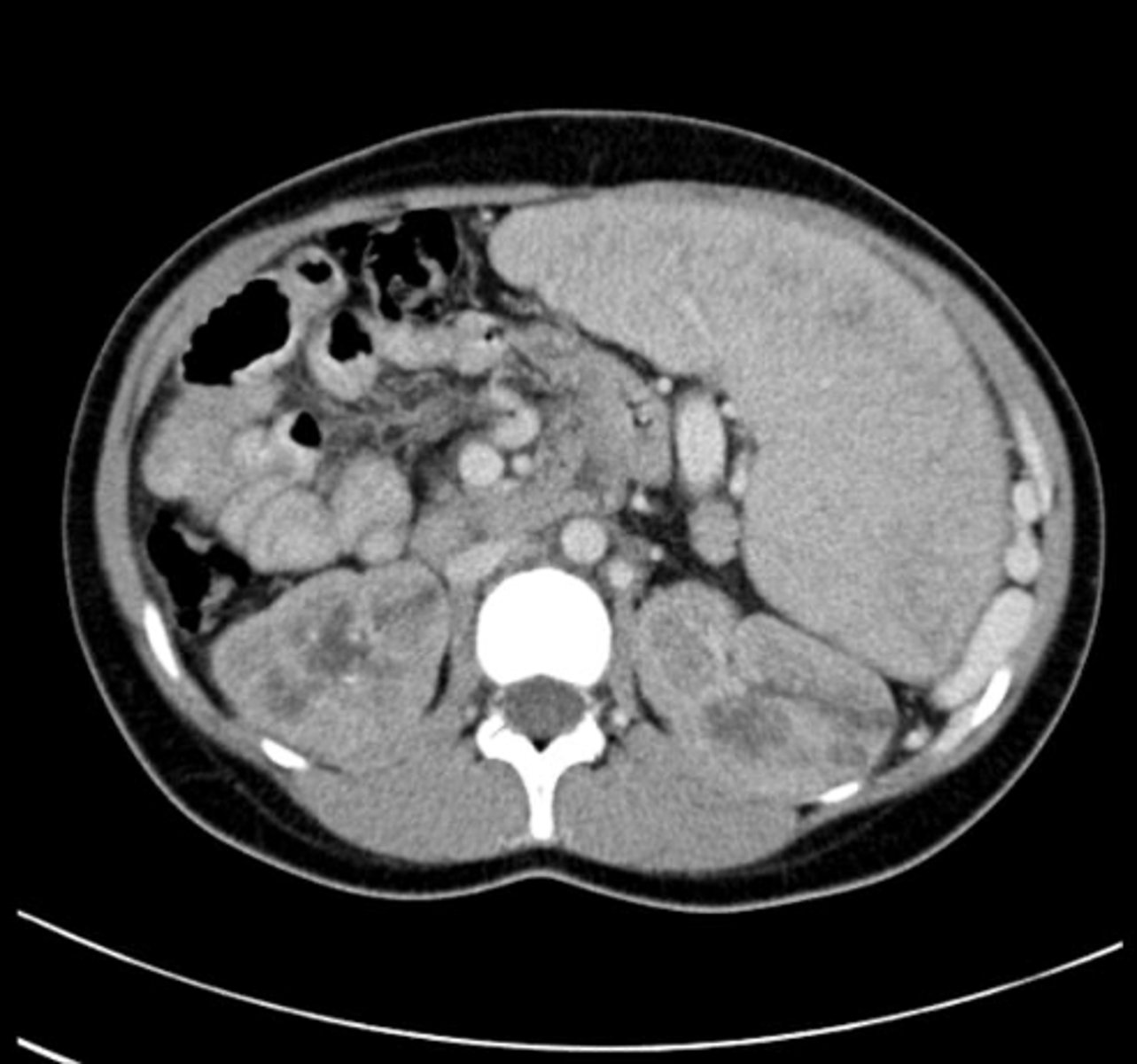 <p>US: Numerous tiny cysts (microcysts), uniform in size, Bilateral renal enlargement, echogenic kidneys</p><p>CT/MRI: hepatic fibrosis</p>