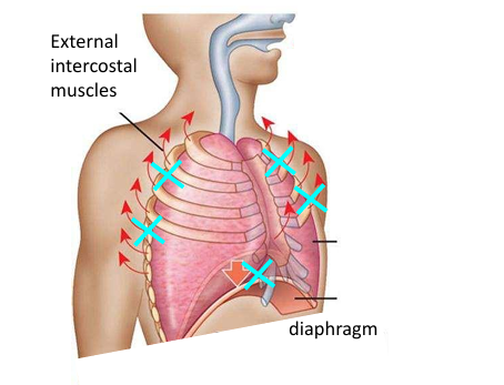 disorders restricting chest wall or lung expansion, reduce compliance, reduce ability to change lung volume