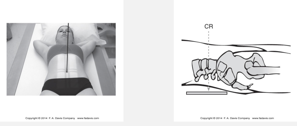 <p>What structures can be visualized in an AP lumbar spine radiograph?</p>